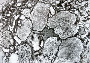 Whipple disease Whipple disease